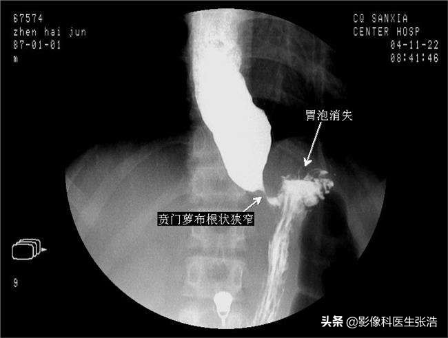 喝两口咽下去的“钡餐”检查，能发现食管和胃部的问题吗？#辟谣#