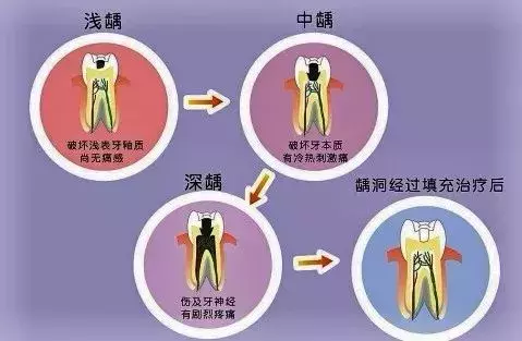 补牙要趁早！小龋坏久拖不治，最后花费上万，冤不冤？