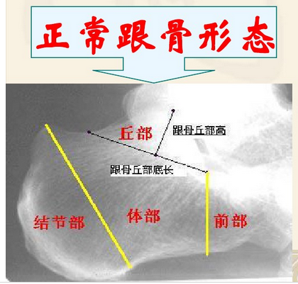 正常婴儿脚后跟图片（摔跤后脚后跟疼痛）