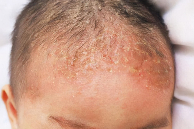 那么,什么是"蒙古斑"呢?