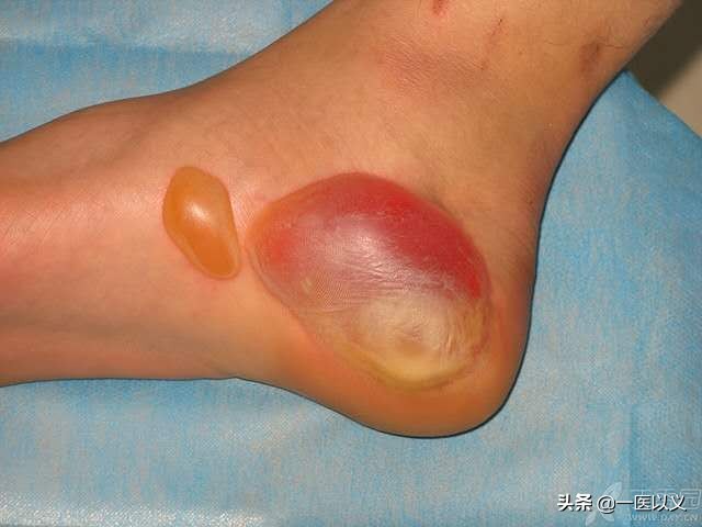 因为,不同的烧伤(烫伤)深度,对应着有不同的处理方法.