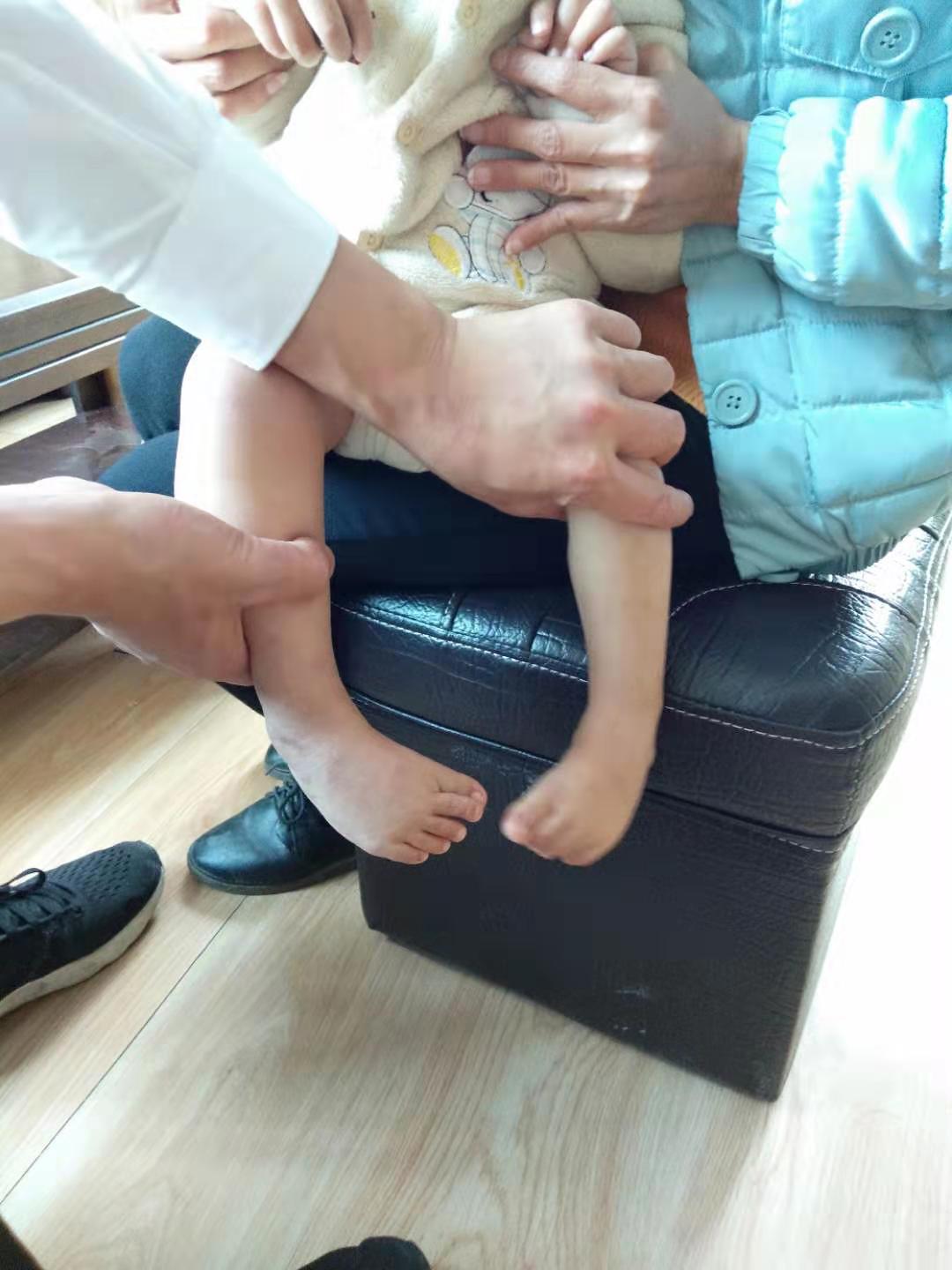 婴儿足内翻是什么原因造成的(孕期发现宝宝患马蹄内翻足) - 乐宝宝贝