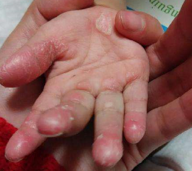 儿童手指头脱皮是什么原因(孩子老是手蜕皮只是干燥吗) - 百百科