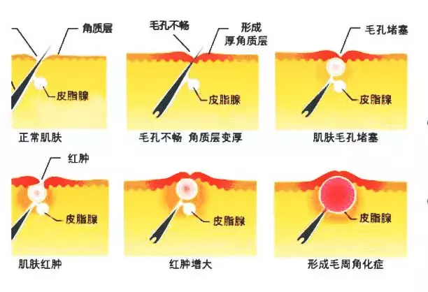 夏天令人讨厌的‘“鸡皮肌肤”’，皮肤医生：3个妙招可改善