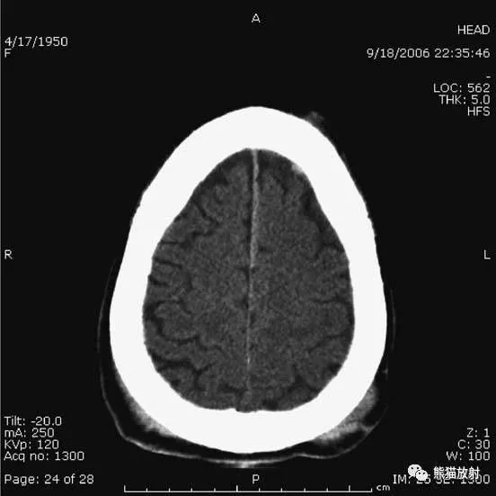 简明又详细的头部CT读片详解，收藏