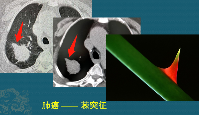 从CT片上看肺癌结节，有4个常见表现，医生教你入门学CT