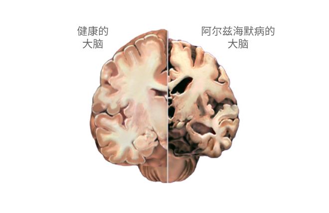 「直观明了」用图解释阿尔兹海默病的发病机制