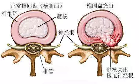 腰椎间盘突出打球戴护腰好吗(“腰椎间盘突出症”拍了拍你)