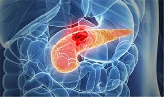 东北大学医院（胰腺癌晚期能活多久）