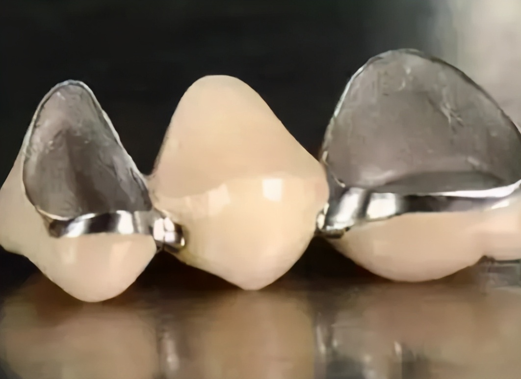 烤瓷牙与全瓷牙的价格全瓷牙比烤瓷牙贵那么多