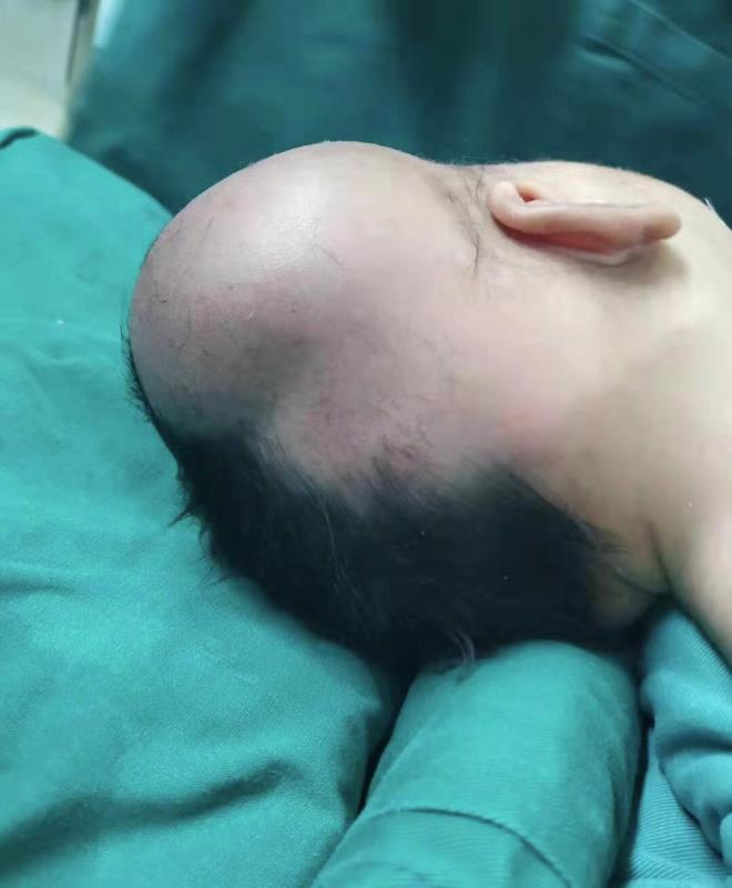 顺产的婴儿头部血肿(孕妇散步时突然生产) - 乐宝宝贝