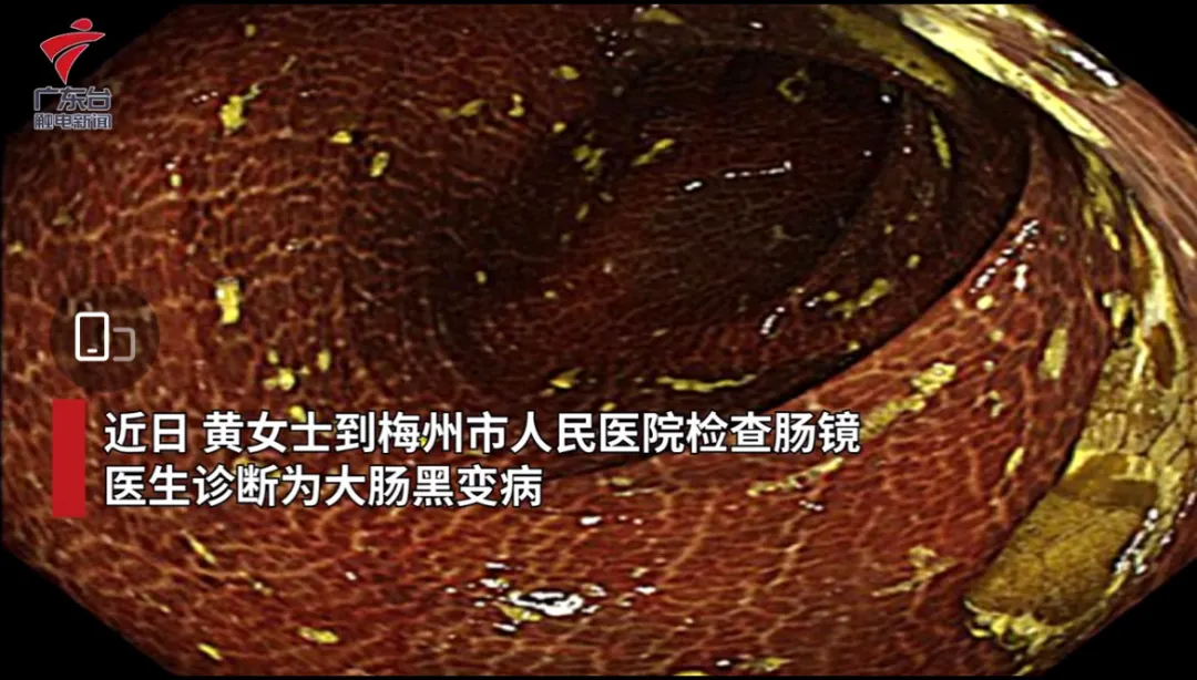女子喝了2年通便茶,肠子黑得像“煤炭”,背后真相扎心了……