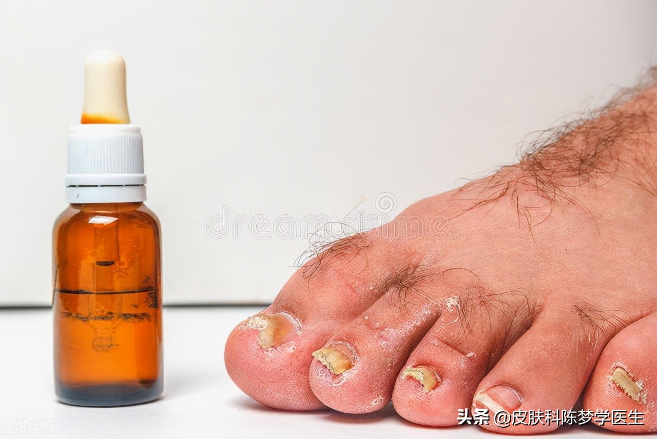 十几年的老脚气，反反复复老不好该怎么办？
