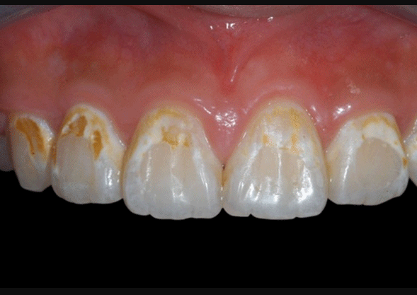 牙齿脱矿早期图片(辟谣) - 赤虎壹号