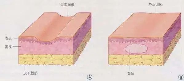 玻尿酸真的那么神奇吗？保湿还能垫鼻子？