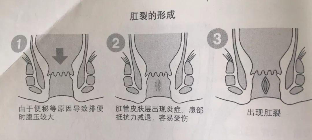 由于肛管的正前,正后方缺少肌肉有效的支撑保护,故大便干硬时容易撕裂