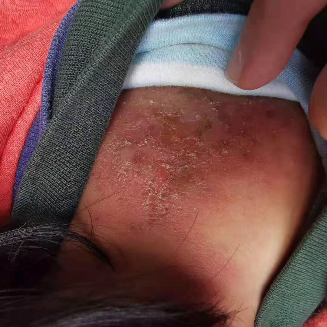 儿童传染性软疣怎么处理比较安全