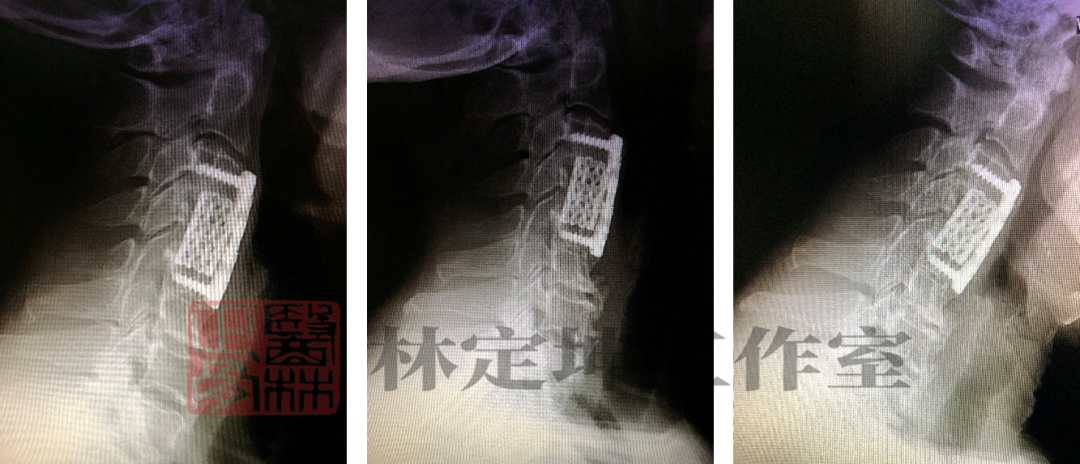 医林正骨丨术后颈痛复发又要做手术？医生：做牵引就能解决