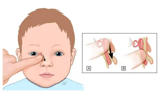 孩子总是泪汪汪、眼屎多，是什么情况？