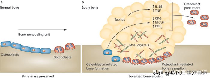 痛风患者都会长出痛风石吗？医生介绍痛风石治疗的四种方法