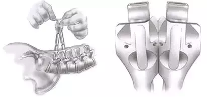 SEXTANT Ⅱ经皮椎弓根螺钉系统