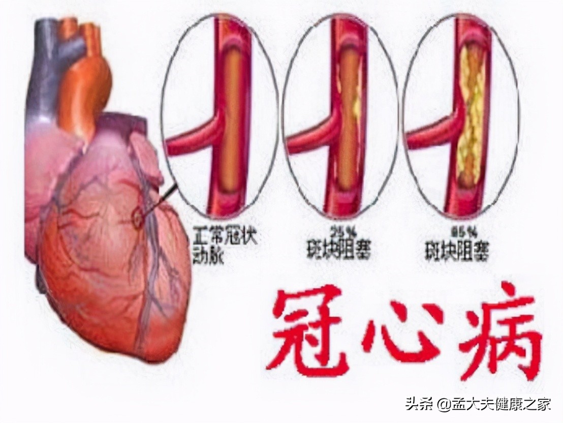 患有冠心病服用这2种药物，有效减少心肌缺血发作，提高生活质量
