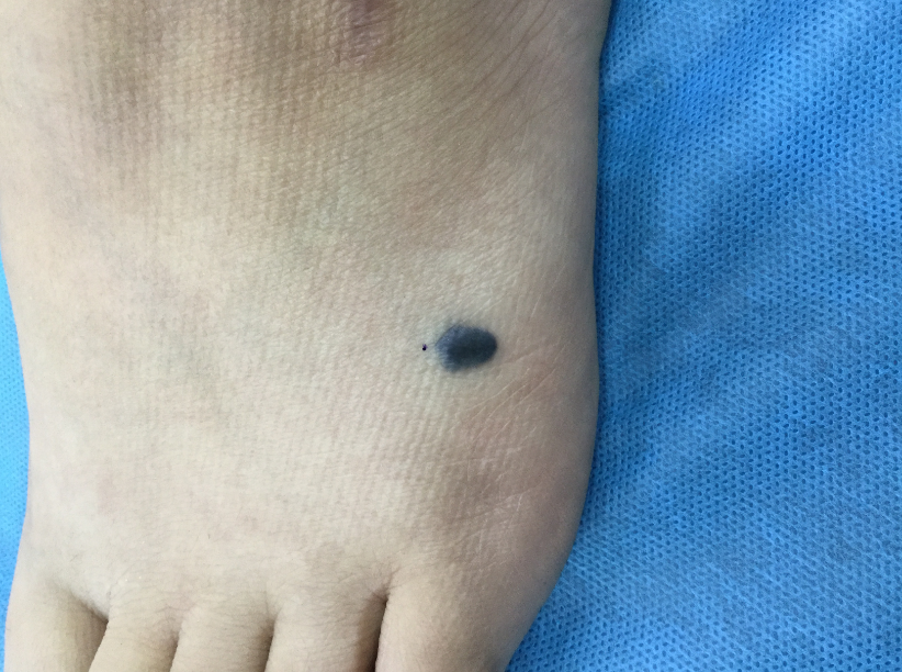 肚子上的红色斑块图片(身上出现这种斑) - 赤虎壹号