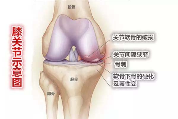 膝关节骨性关节炎“换关节”其实没那么可怕