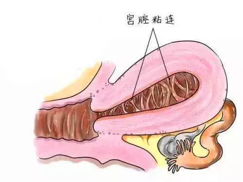 宫腔镜是个啥？有啥用？到底是检查还是手术？