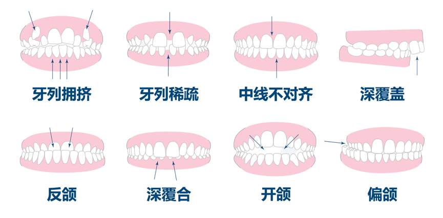 孩子牙齿排列不整齐、地包天是怎么回事呢？该如何处理？