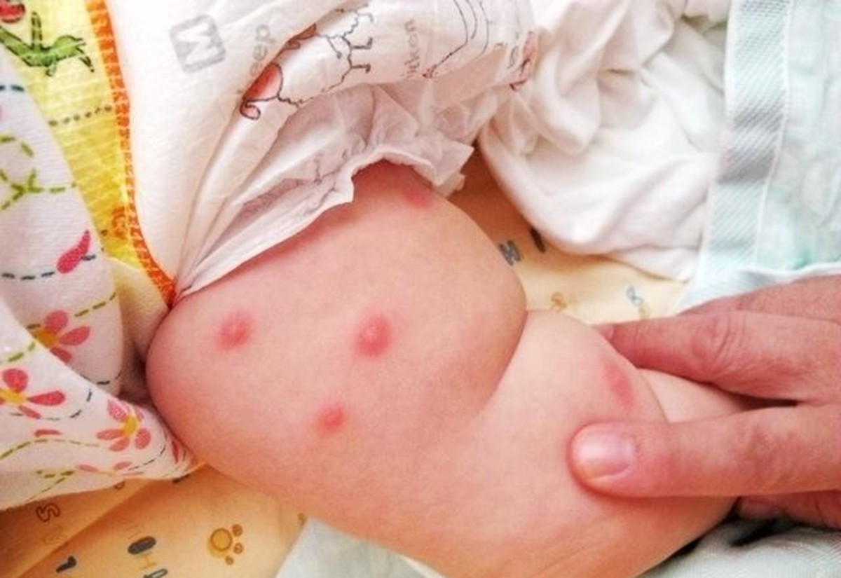 宝宝被毒蚊子咬了图片图片
