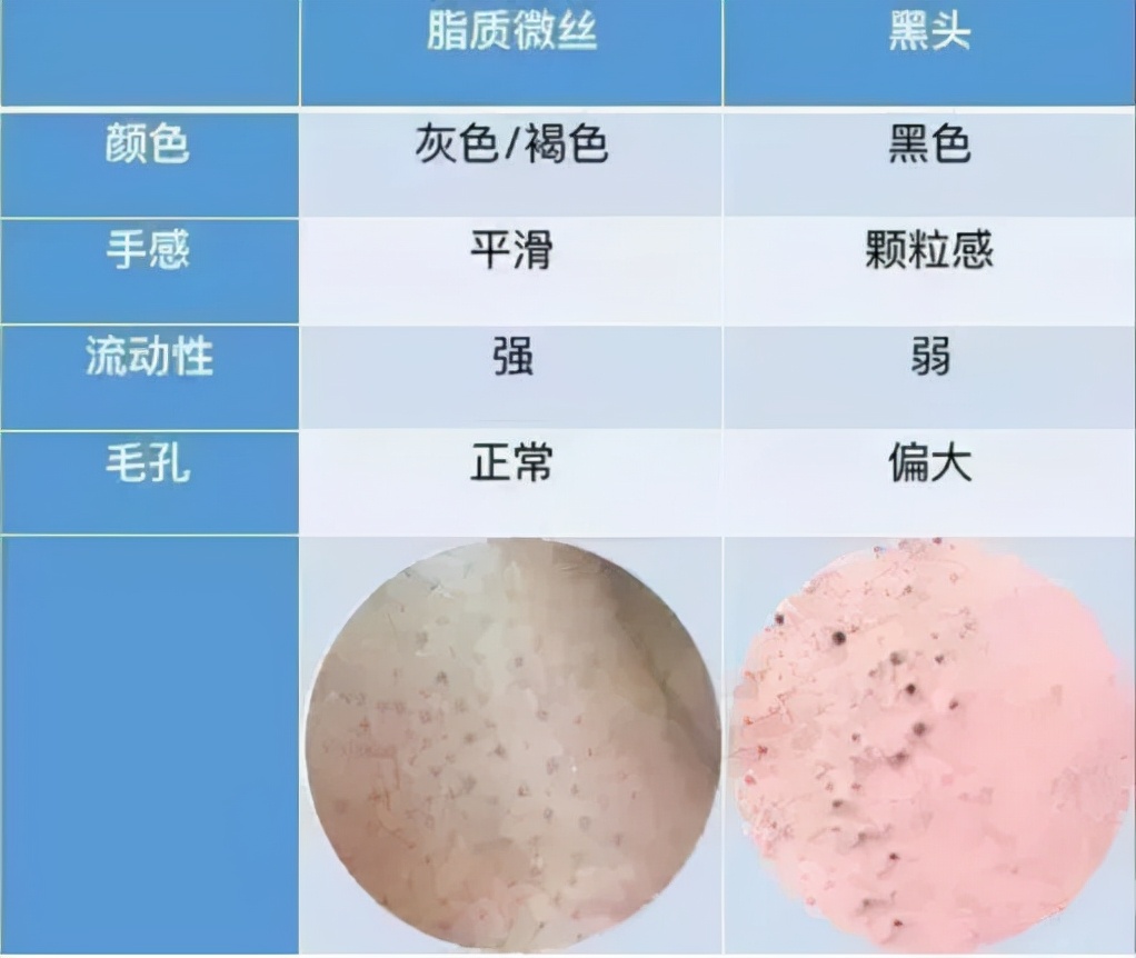 你鼻子上的真的是黑头吗？教你正确祛黑头