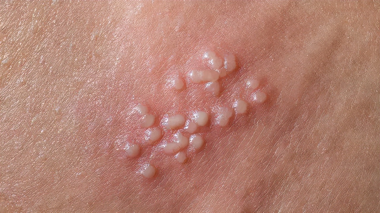 手上起小水泡痒怎么办