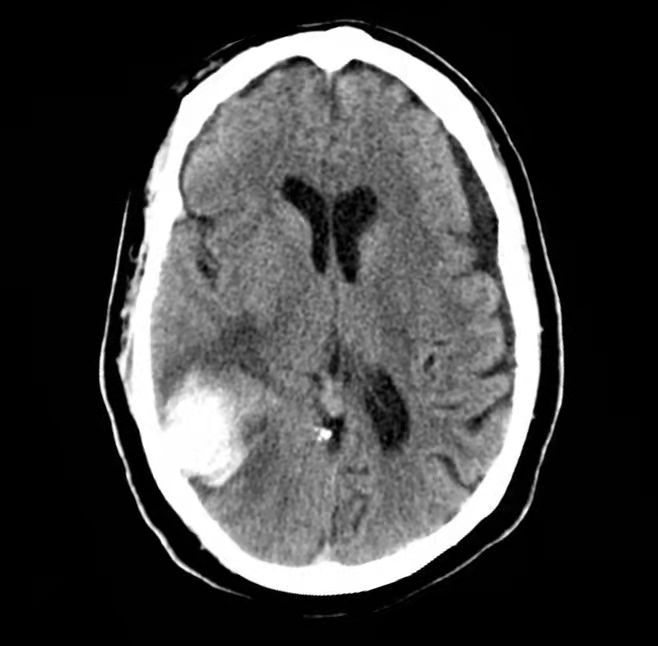 脑出血图像04做ct对人体会有危害吗?
