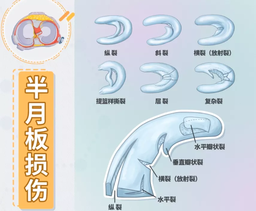 有些人年纪轻轻，但「半月板」已经撑不住了……