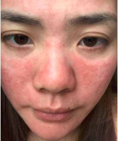 这几天起了皮肤起红疹该怎么办好呢?脸上红痒可能是什么引起的?