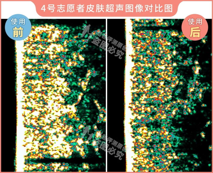 网红家用美容仪真的有效吗？2个多月的跟踪实测结果来了