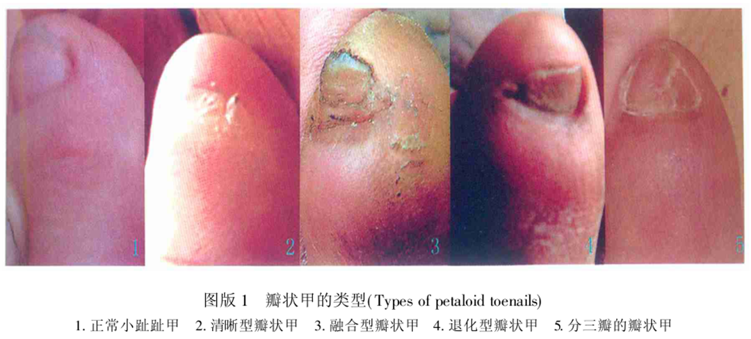 瓣状甲被分为3种类型:清晰型,融合型,退化型.