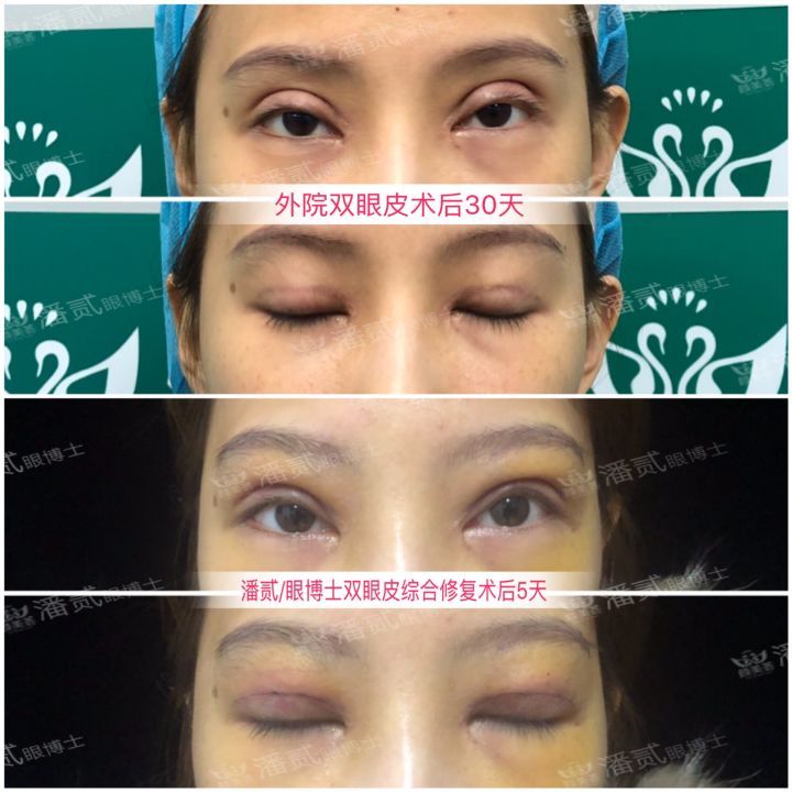 韩式三点双眼皮可以维持几年(一场失败的双眼皮手术，使19岁少女容貌畸形，生活停顿，恳求急救)