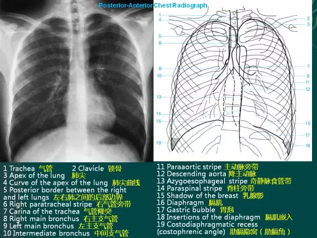 纵隔解剖 + 纵隔疾病X线诊断要点