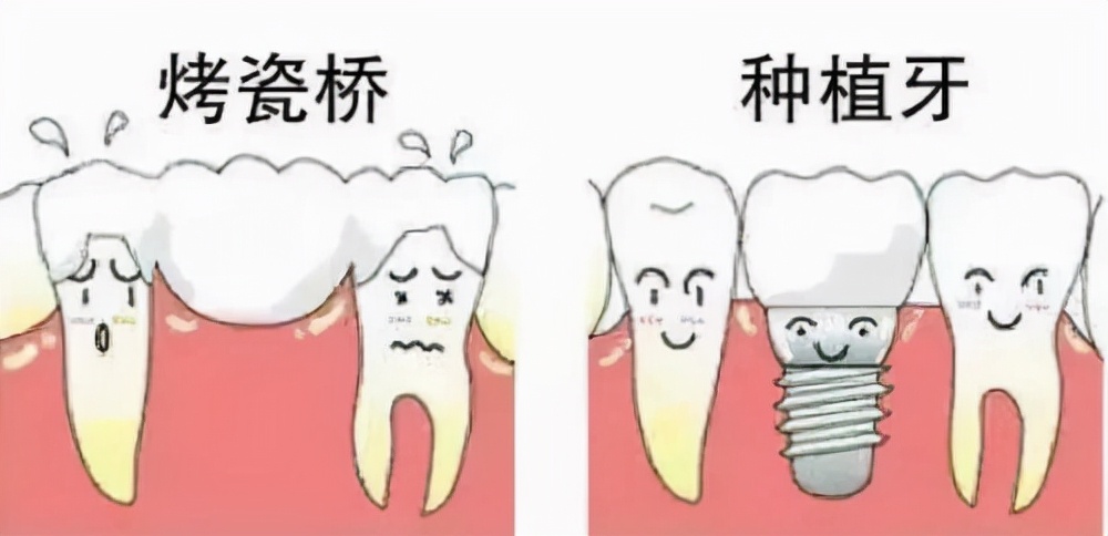 「牙齿那些事儿」No.64丨对于20岁的少年，种牙和镶牙哪个选择好