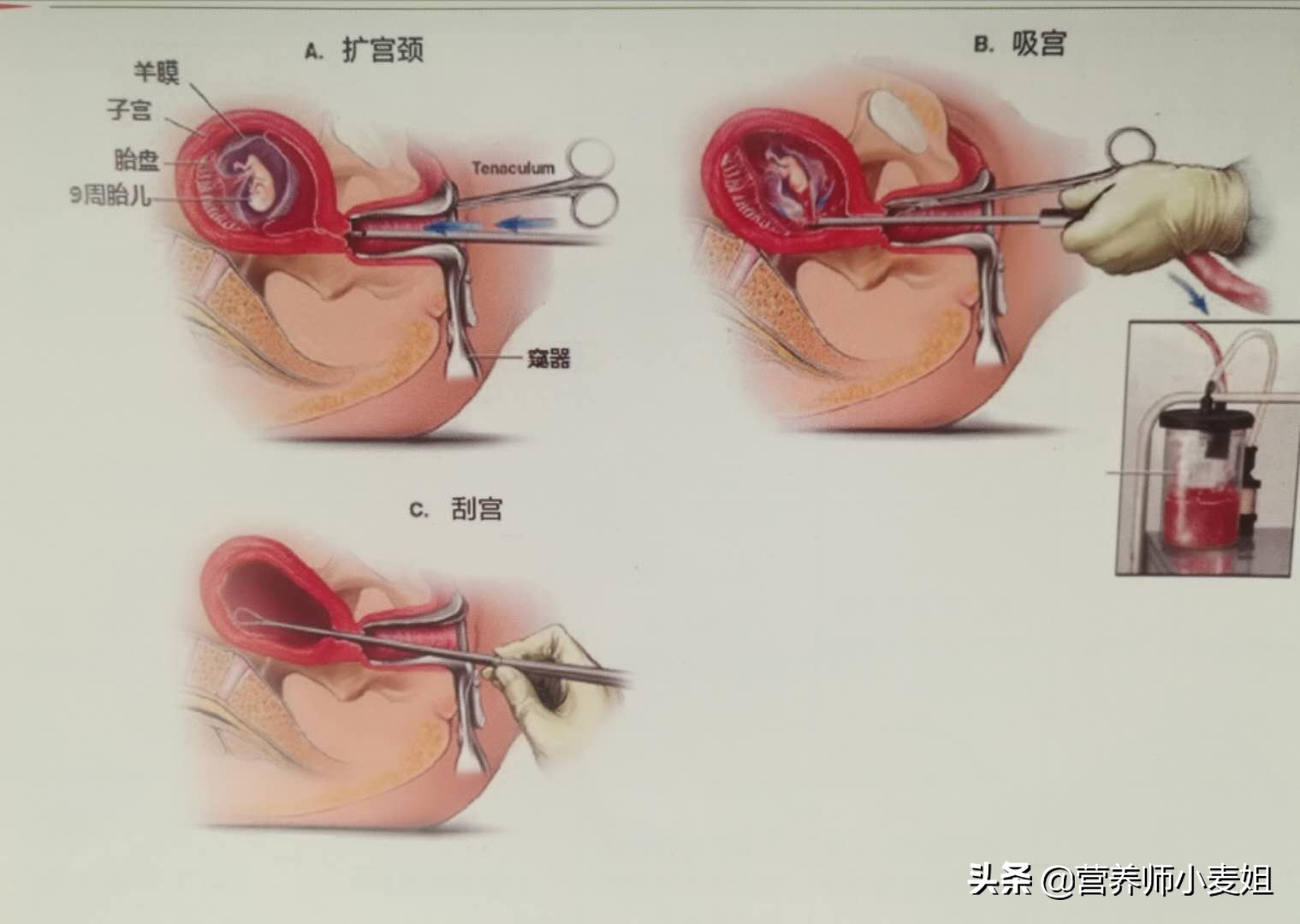 刮宫过程图片