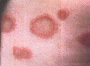 蝶形红斑早期图片图片