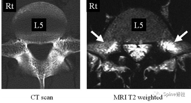 从诊断到治疗：全面解析腰椎峡部裂(lumbar spondylolysis)