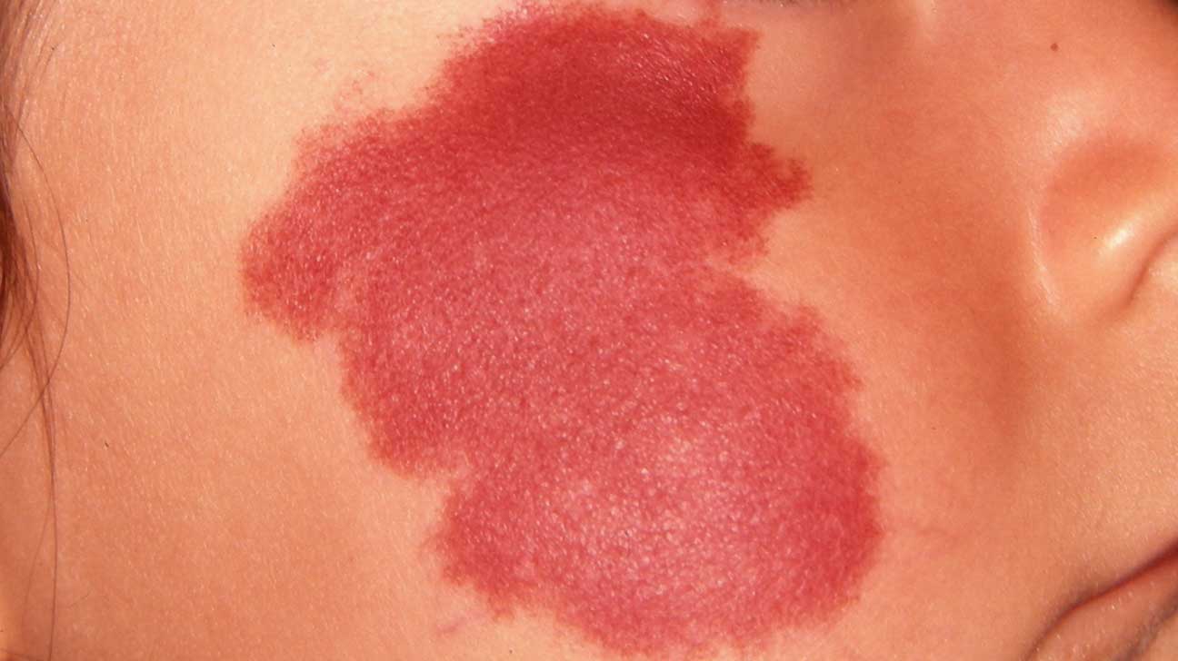 人人身上都长的"红色痣",有3种竟是大病预兆