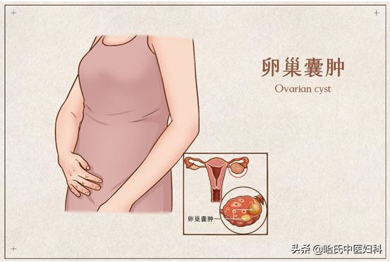 卵巢囊肿成因及是否影响生育能力解析