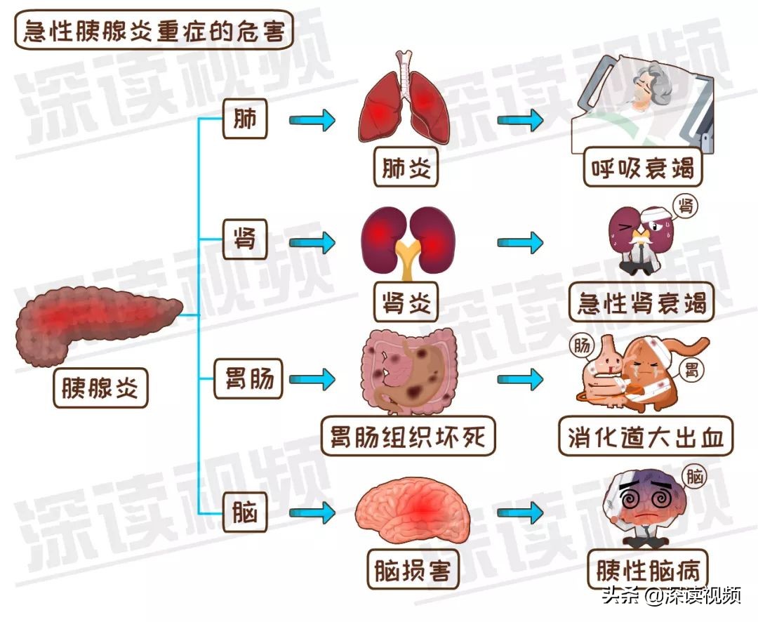 发作起来腹痛似刀绞,致死率高达10%,解密能要命的腹痛之胰腺炎