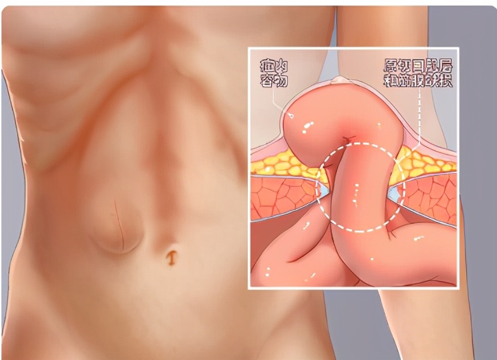 警惕腹部手术后常见并发症-腹壁切口疝