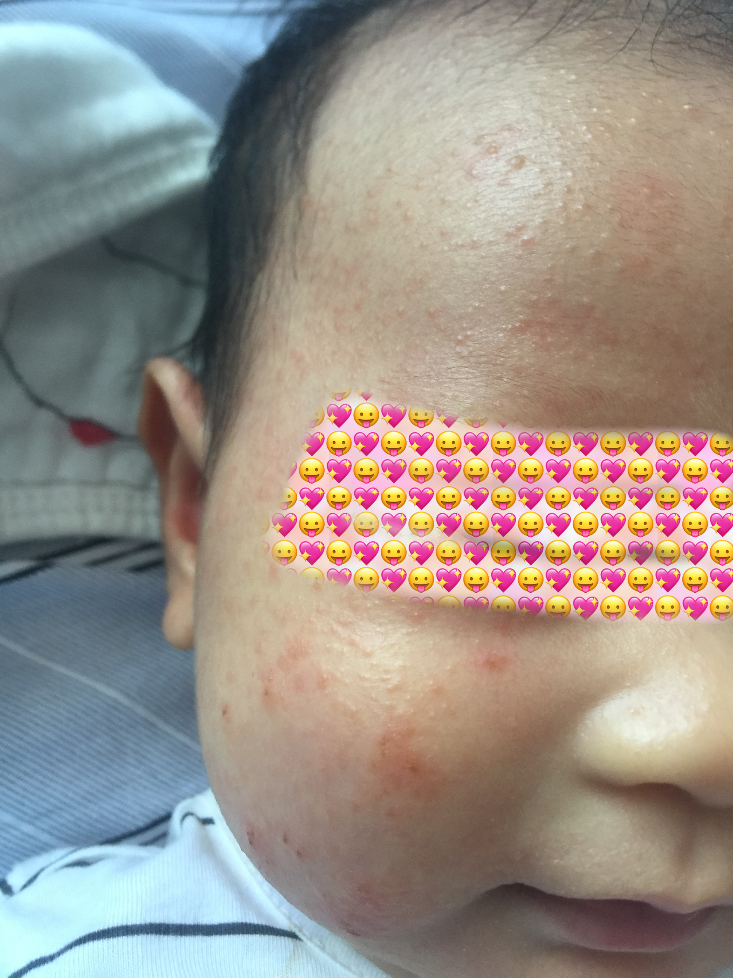 婴儿湿疹过敏源怎么查(和宝宝湿疹大战了几百回合) - 乐宝宝贝