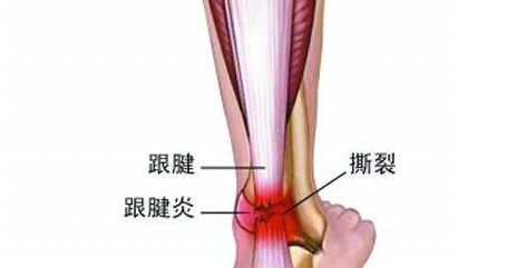 跟腱断裂属于几级伤残图片